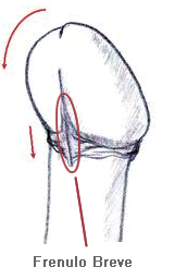 frenulo pene