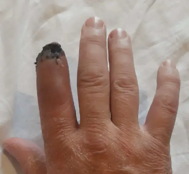 amputazione e necrosi seconda falange mano destra