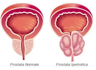 prostata ipertrofica